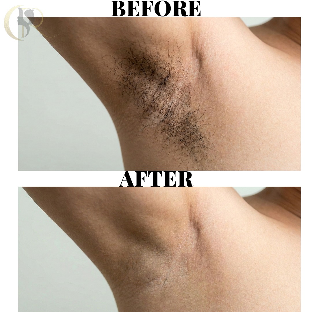 Cosmo Radiance result: Underarms Clearance